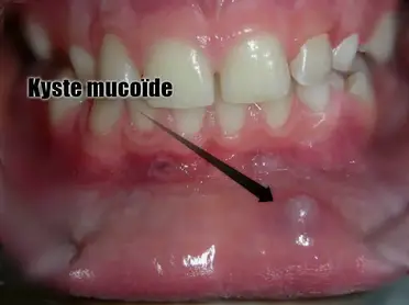 Kyste Mucoïde Dans La Bouche, Que Faire ? [+ Traitements Naturels]