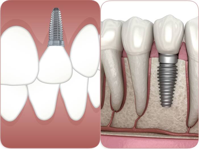 autres solutions que l'implant dentaire