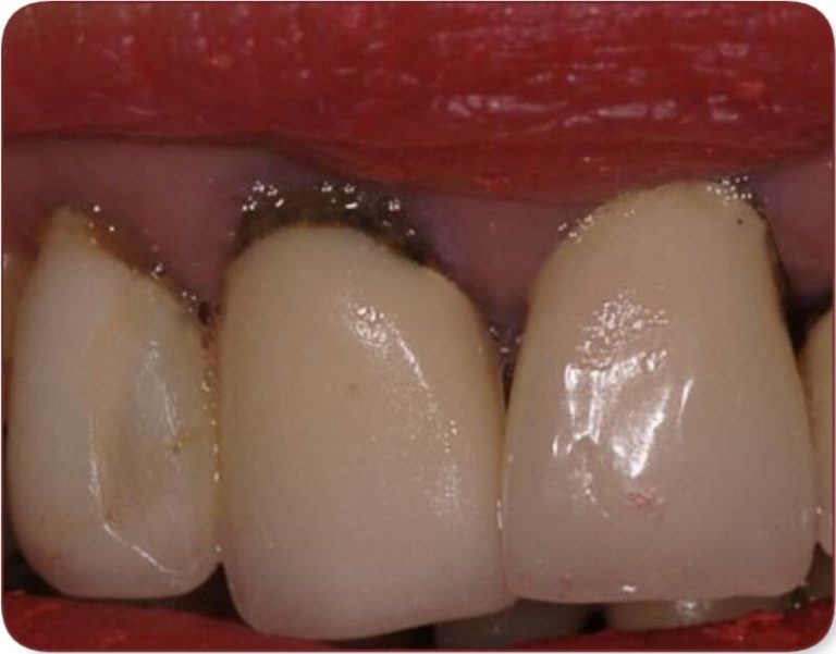 Gencive noire entre deux dents
