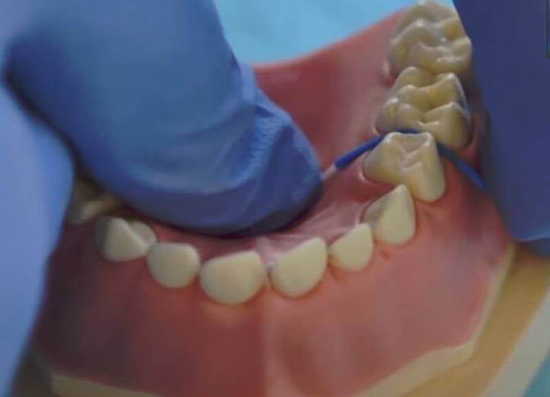 Séparateurs orthodontiques