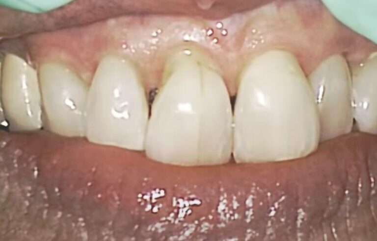 Fissure dentaire linéaire