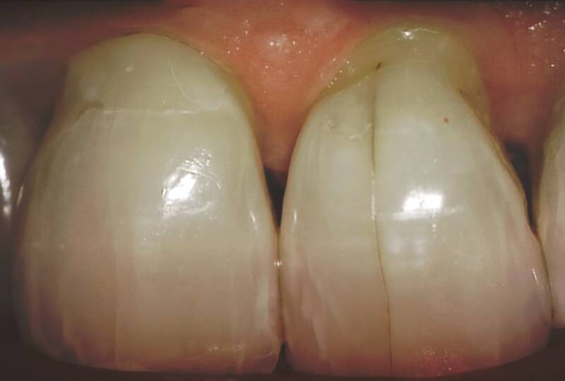 Un fendillement dans une dent peut-il se guérir de lui-même