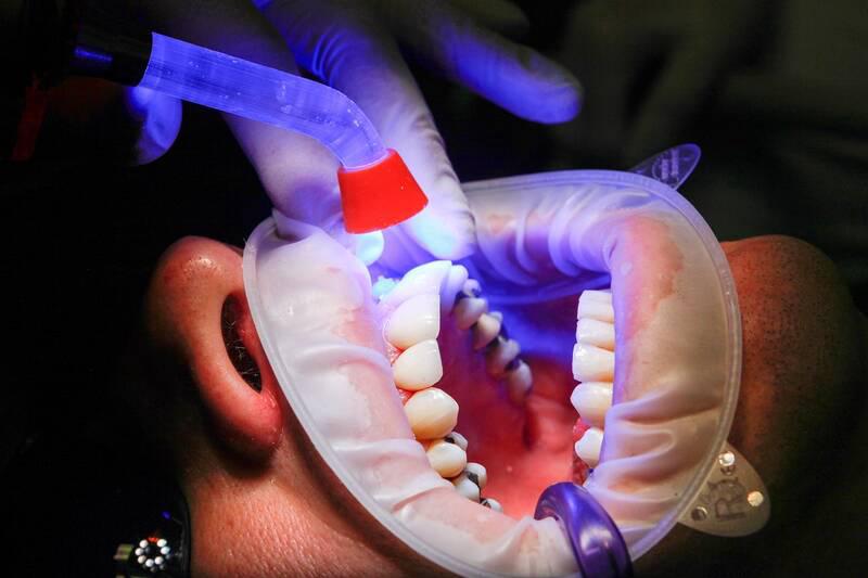 Quels sont les défis de la pose de facettes sur des dents antérieures usées ou courtes